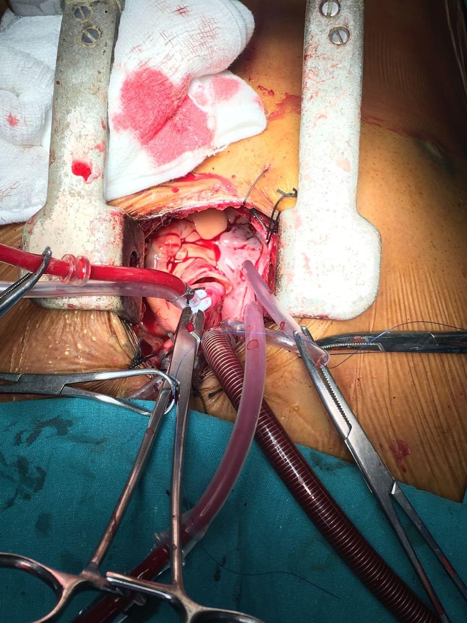 Minimally Invasive Aortic Valve Surgery