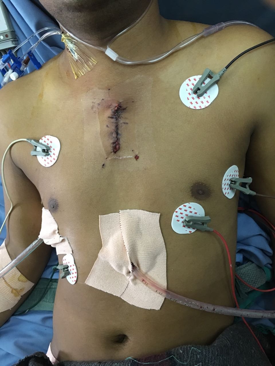 POST OP SCAR - DR Sourabh Sharma